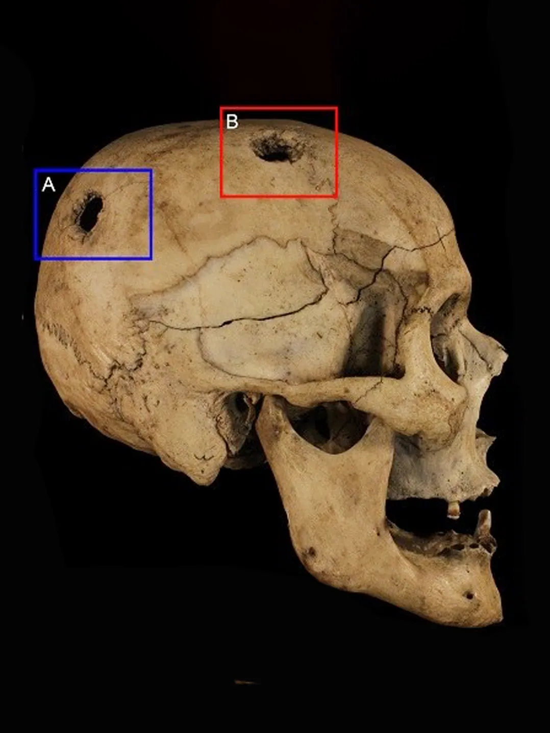 Forensic anthropologist 3D scanning bones and skeletal remains at a death scene